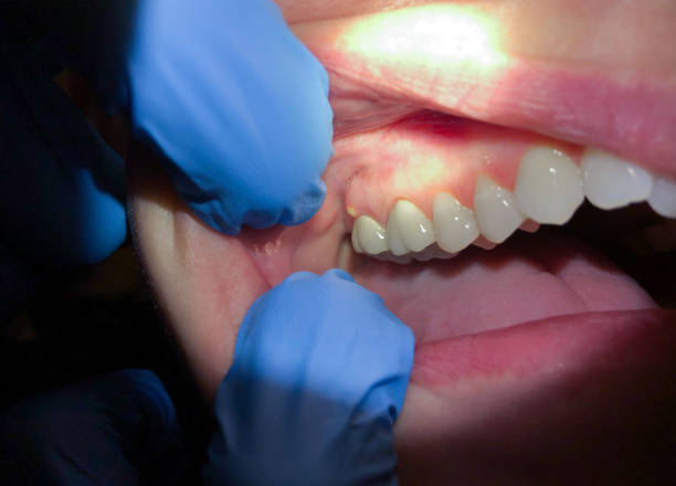 Best Emergency Dental Care for Broken or Chipped Teeth in Port Clinton, OH
