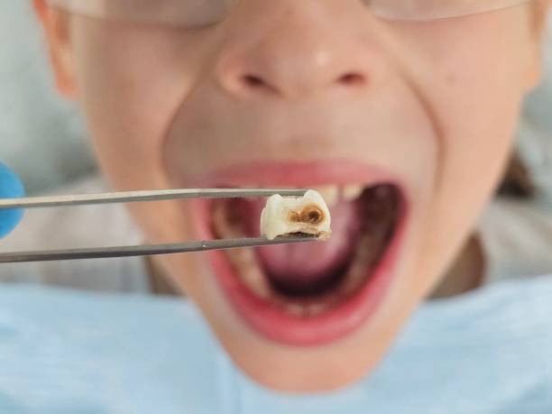 Best Emergency Treatment for Dental Infections or Abscesses in Port Clinton, OH